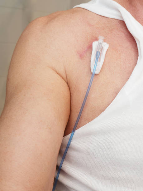 Tube For Intravenous Fluids Injections To Implantable Port For Chemotherapy  Stock Photo - Download Image Now - iStock