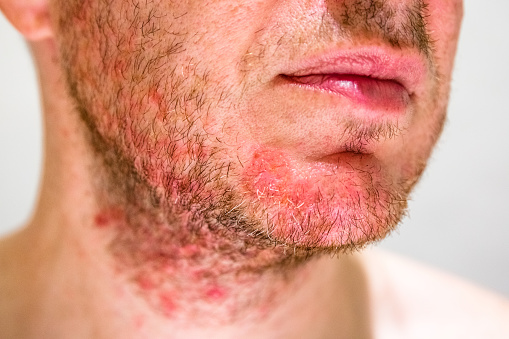 Hombre con dermatitis seborreica en la zona de la barba photo