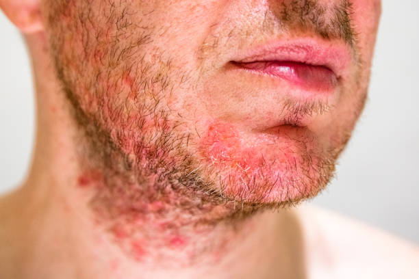 Man with seborrheic dermatitis in the beard area Detail of man's chin with seborrheic dermatitis in the beard area dermatitis photos stock pictures, royalty-free photos & images