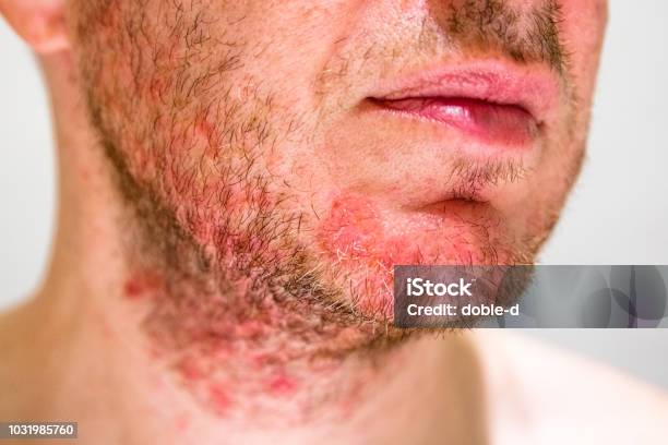 Man With Seborrheic Dermatitis In The Beard Area Stock Photo - Download Image Now - Seborrheic Dermatitis, Human Face, Anthropomorphic Face