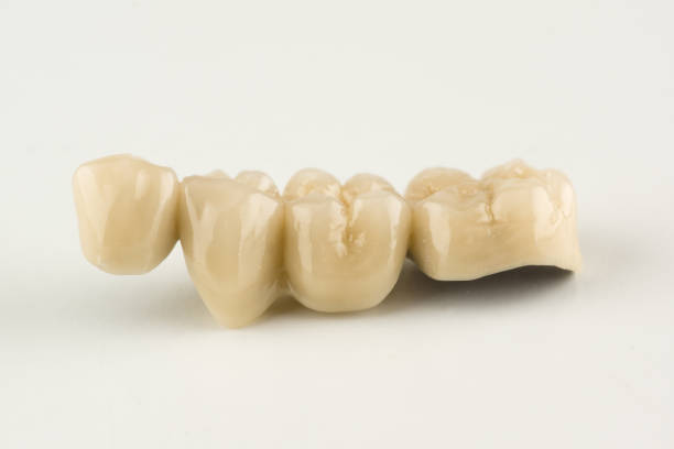 istock cermet dental bridges 1032089124