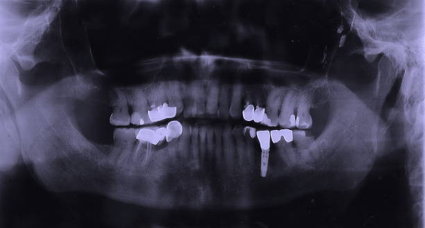 Panoramic negative image facial of old male with one implant tooth stock photo