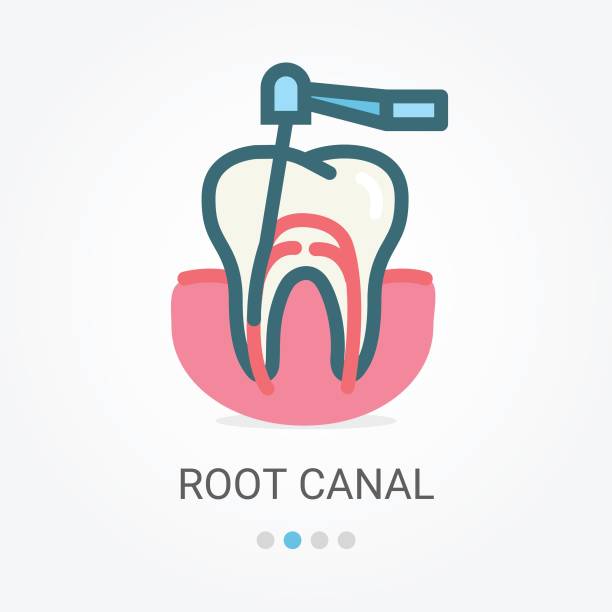 636 Root Canal Illustrations & Clip Art - iStock | Endodontics, Tooth pain,  Dental