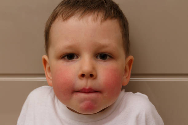the boy has red cheeks, a rash on his cheeks in the child, a rash on his cheeks from allergies, an allergic reaction to food, citrus. an allergy to medicines. child with allergies. red cheeks in the boy, in a white T-shirt, antihistamines.atopic dermatitis el chico tiene las mejillas rojas, una erupción en las mejillas en el niño, una erupción en las mejillas de las alergias, una reacción alérgica a los alimentos cítricos. una alergia a los medicamentos. niño con dermatitis allergies.atopic