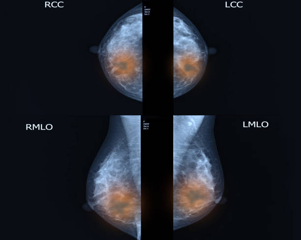brust-krebs-bilder - mammogram mri scan breast breast examination stock-fotos und bilder