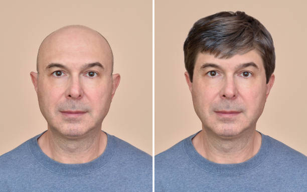 istock Man with and without hair 1033643576