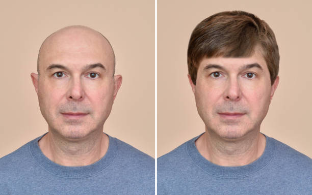 istock Man with and without hair 1033643638