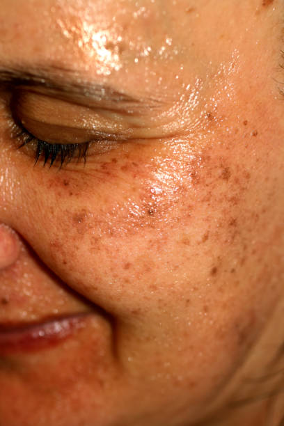 istock Pigmented spots on the face. Pigmentation on cheeks 1033834504