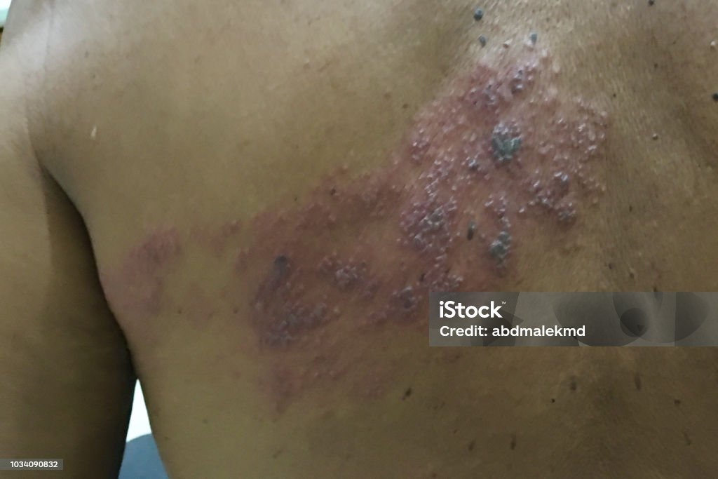 Shingles Def Shingles Stock Photo - Download Image Now - Adult, Blister, Dermatology ...