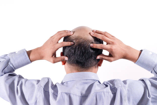 istock bald businessman with his head on scalp view from behind with white background 1034115520