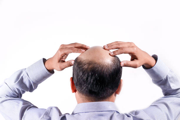 bald businessman with his head on scalp view from behind with white background - completely bald fotos imagens e fotografias de stock
