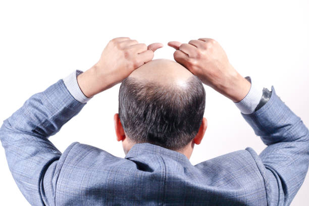 bald businessman with his head on scalp view from behind with white background - completely bald fotos imagens e fotografias de stock