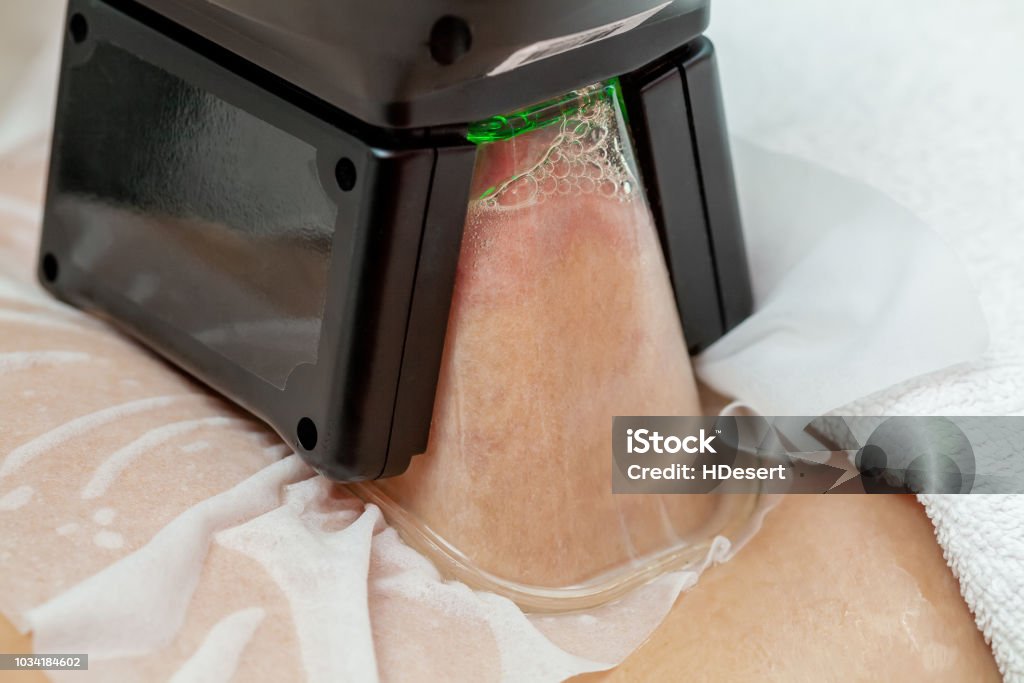 Woman getting cryolipolysis fat treatment in professional cosmetic cabinet Woman getting cryolipolysis fat treatment procedure in professional cosmetic cabinet or spa center Improvement Stock Photo