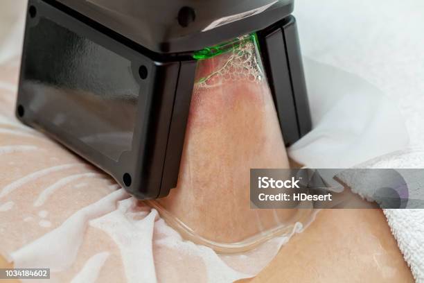 Woman Getting Cryolipolysis Fat Treatment In Professional Cosmetic Cabinet Stock Photo - Download Image Now