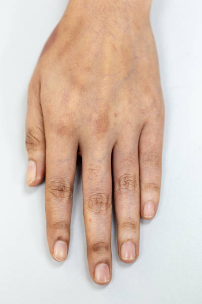 istock A physical of tissue, nerves, tendons at hand. 1034364838