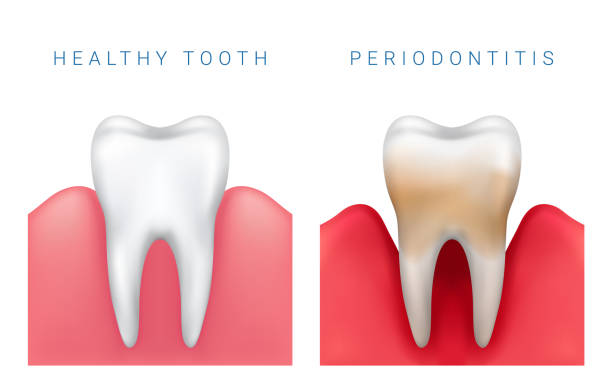 vektor-medizinische illustration realistisch gesunde zähne und parodontitis erkrankung - gums stock-grafiken, -clipart, -cartoons und -symbole