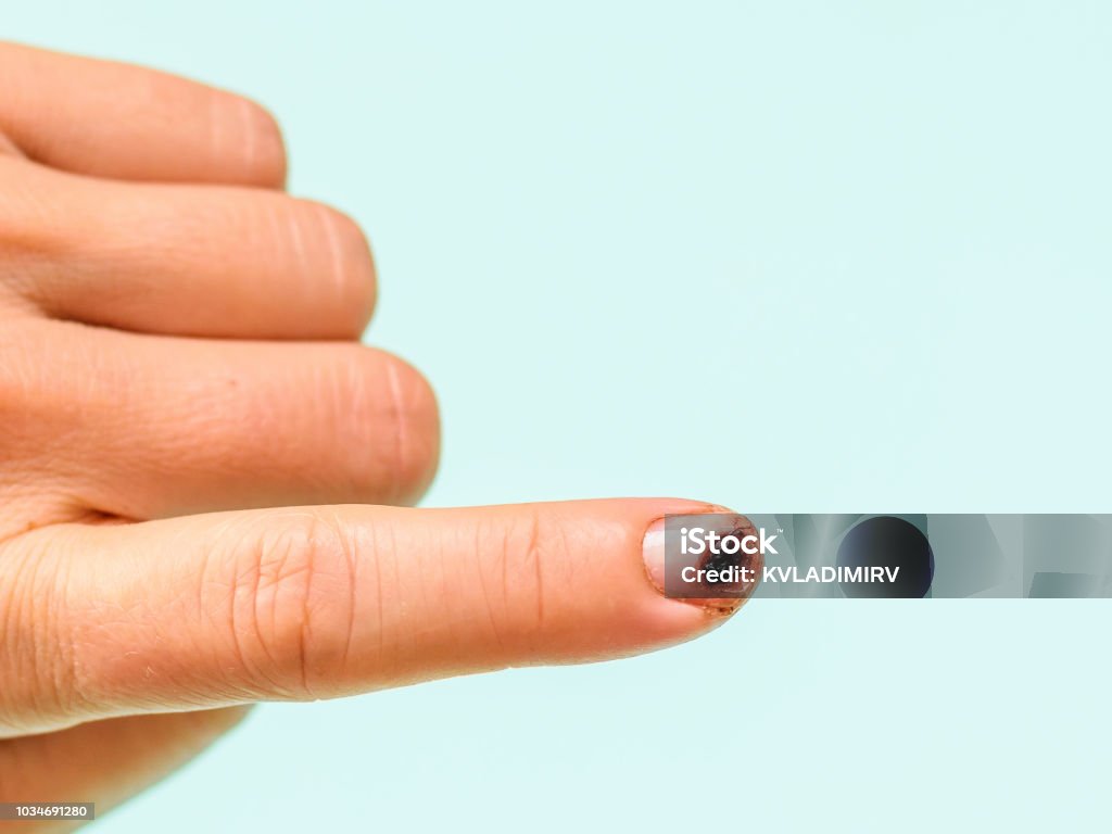 Knife-damaged index finger of the left female hand on a light blue background. Knife-damaged index finger of the left female hand on a blue background. Damage to the hand in a domestic situation. Crushed Stock Photo