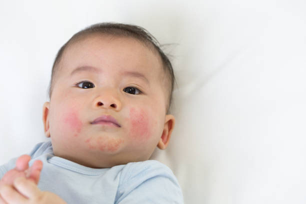 istock Skin rashes in babies concept 1034739776