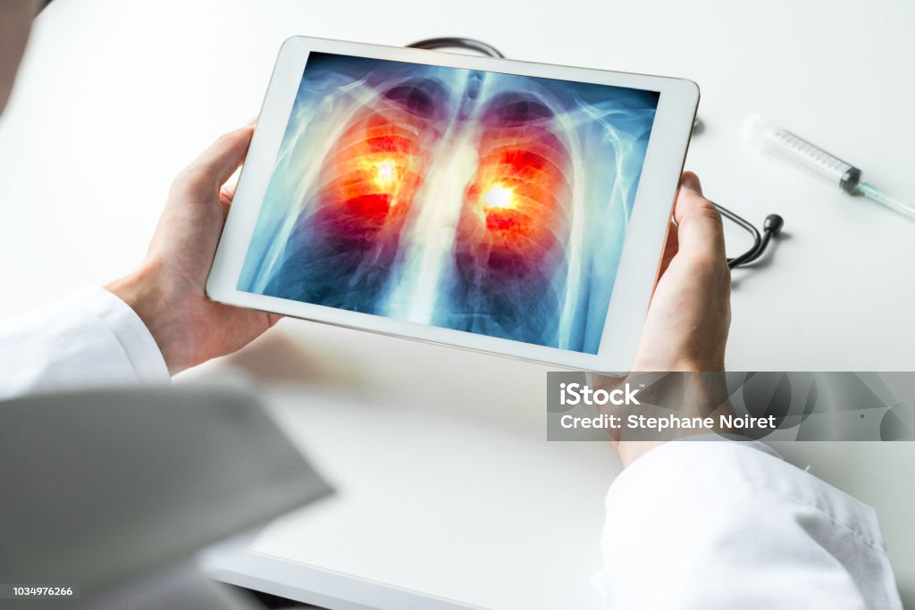 Dottore che guarda una radiografia di cancro ai polmoni su tablet digitale. Concetto di radiologia - Foto stock royalty-free di Medico
