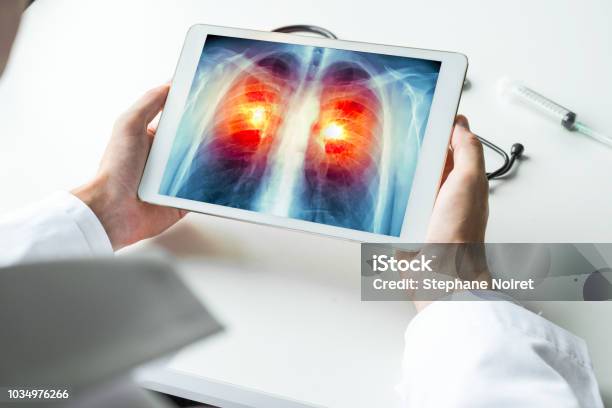 医師デジタル タブレットに肺がんの X 線を見ています放射線のコンセプト - 医師のストックフォトや画像を多数ご用意 - 医師, タブレット端末, コンピュータ