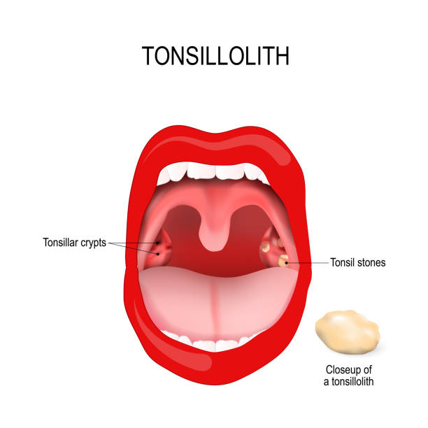 tonsillolith입니다. 편도 선 돌의 클로즈업입니다. 인간의 입입니다. - crypt stock illustrations