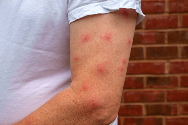 allergic reaction to mosquito bites - stripped shirt imagens e fotografias de stock
