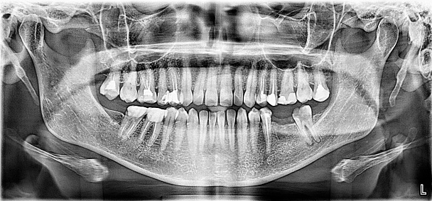 Panoramic X-ray image of upper and lower jaw teeth by tomography. 2D