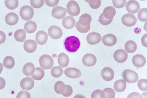 istock Lymphocyte cell in blood smear 1036157064