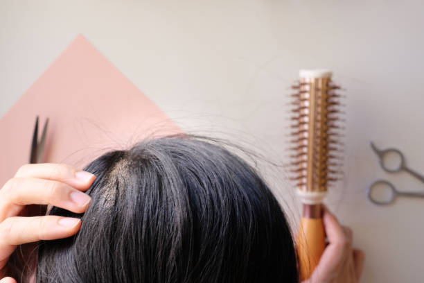 istock hair fall and lost alopecia woman problem on the comb. 1036409838