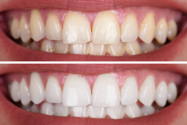 istock Woman's Teeth Before And After Whitening 1037081000