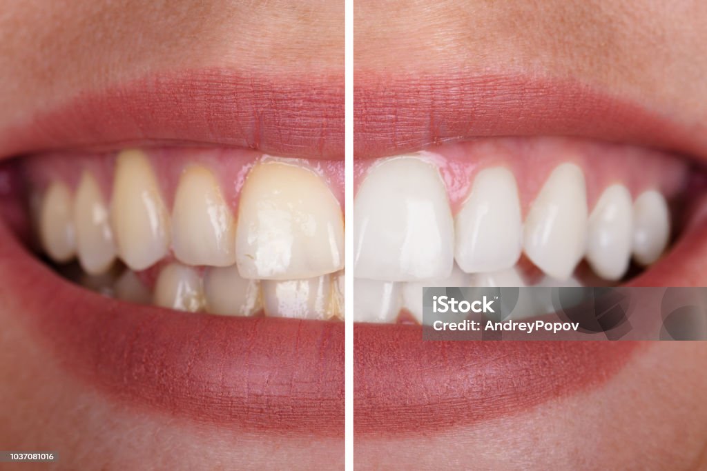 Die Zähne Frau vor und nach der Aufhellung - Lizenzfrei Zahnaufhellung Stock-Foto
