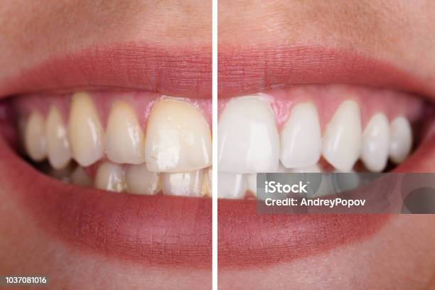 Die Zähne Frau Vor Und Nach Der Aufhellung Stockfoto und mehr Bilder von Zahnaufhellung - Zahnaufhellung, Zahn, Gelb