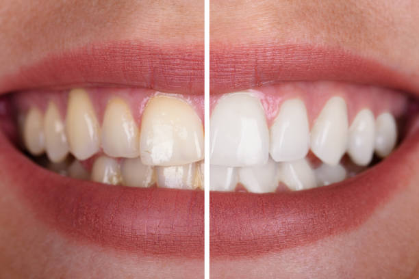 зубы женщины до и после отбеливания - human teeth whitening dentist smiling стоковые фото и изображения