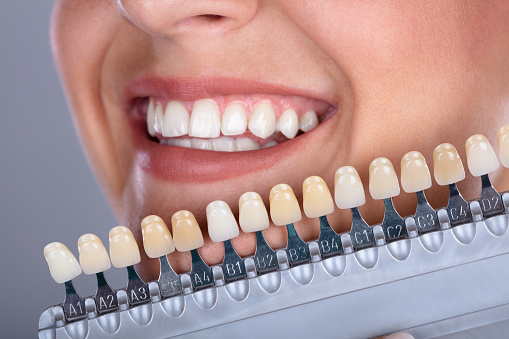 Mujer de coincidencia de color de los dientes de implante photo