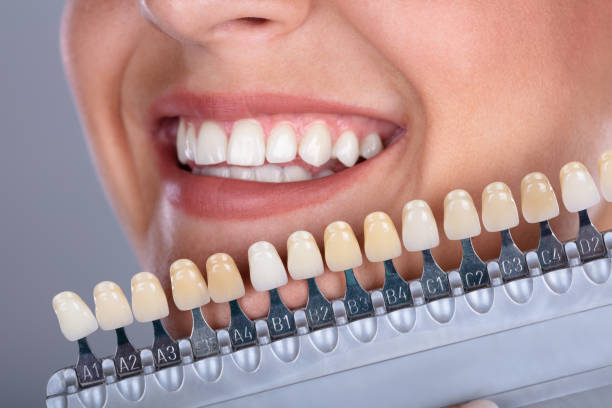 donna che abbina la tonalità dei denti implantari - usare la bocca foto e immagini stock