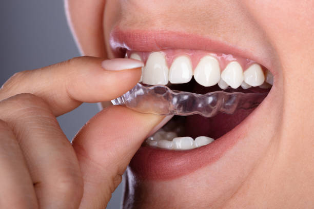 istock Woman Putting Transparent Aligner In Teeth 1037081032