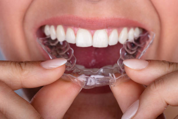 Woman Putting Transparent Aligner In Teeth Close-up Of A Woman's Hand Putting Transparent Aligner In Teeth dental aligner photos stock pictures, royalty-free photos & images