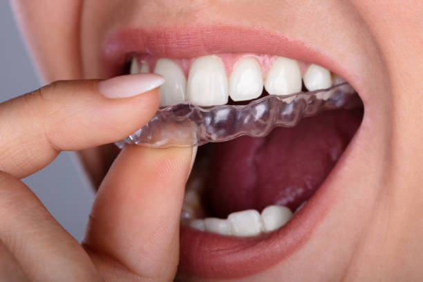 istock Woman Putting Transparent Aligner In Teeth 1037081064