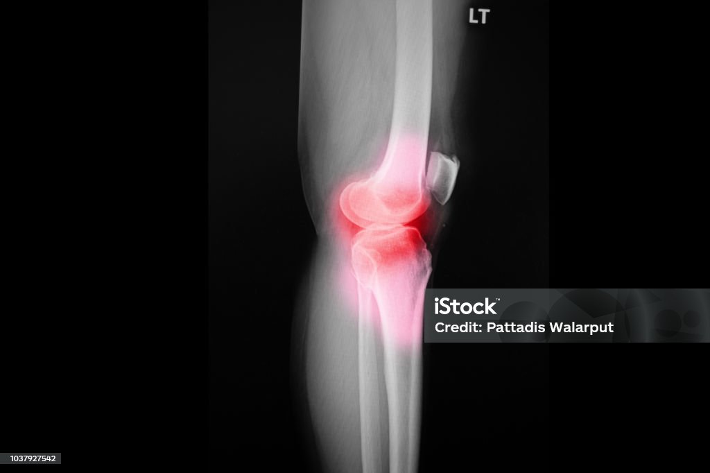 film x-ray knee of osteoarthritis knee patient and artificial joint Adult Stock Photo