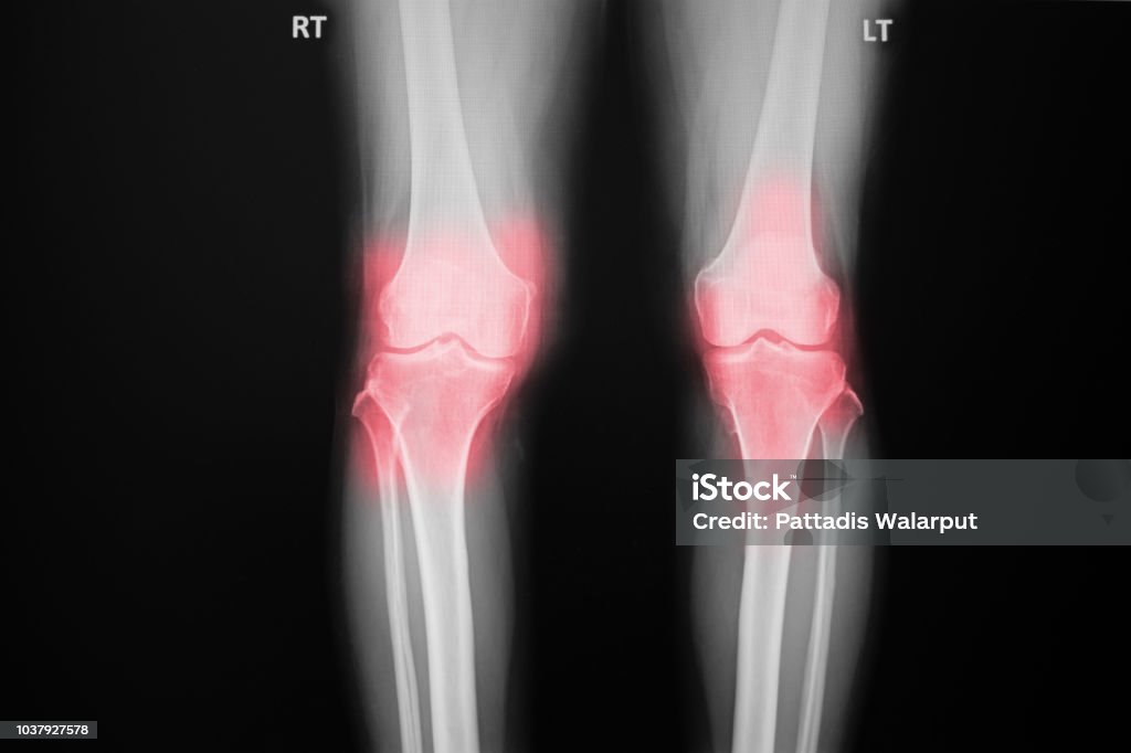 film x-ray knee of osteoarthritis knee patient and artificial joint Adult Stock Photo