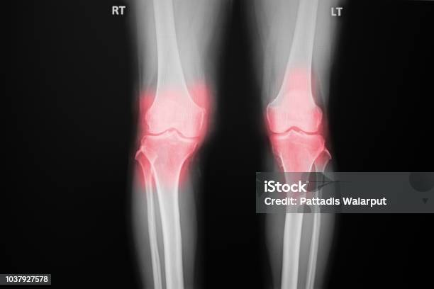 Film Xray Knee Of Osteoarthritis Knee Patient And Artificial Joint Stock Photo - Download Image Now