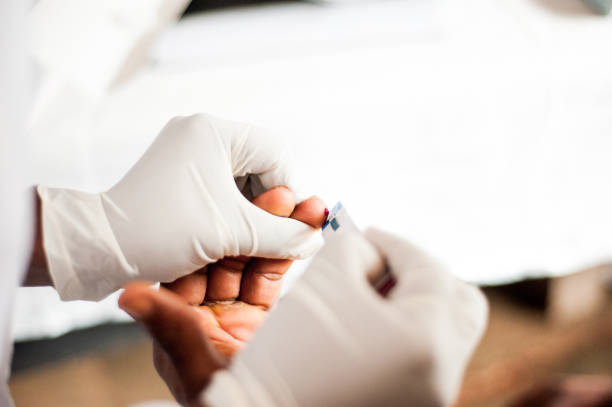 above view of bleeding finger after puncture for free hiv test in african hospital - hiv imagens e fotografias de stock