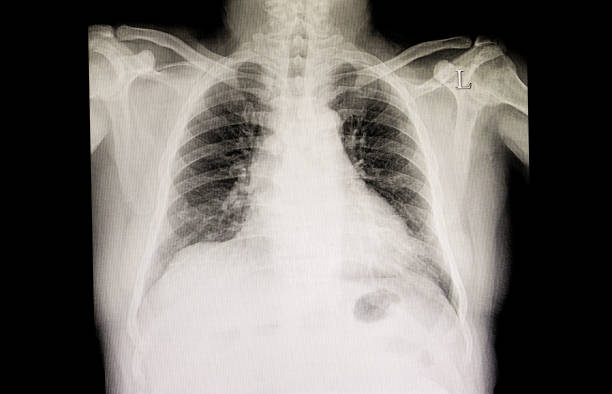 istock Chest xray film 1039351086