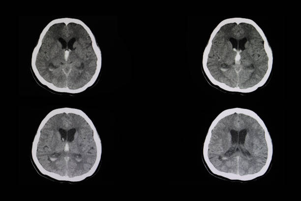 intracerebral hemorrhage CT scan of a brain of a patient with intracerebral hemorrhage from stroke with bleeding into the third ventricle heart ventricle stock pictures, royalty-free photos & images