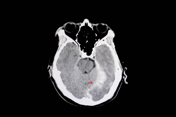 istock intracerebral hemorrhage 1039351176
