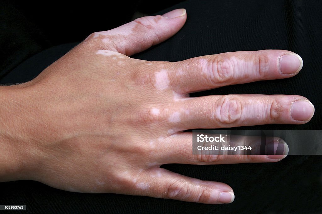 손으로 백반증 피부 질환 - 로열티 프리 백반증 스톡 사진