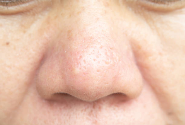 istock Skin problems and facial pores. And not soft. 1039553528