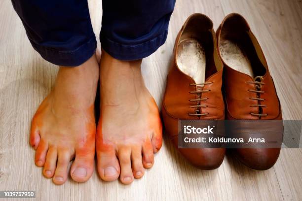 Vermelding Ringlet ontspannen Vrouw Huid Op Voeten Is Gekleurd In Oranje Kleur Met Natte Schoenen  Stockfoto en meer beelden van Been - iStock