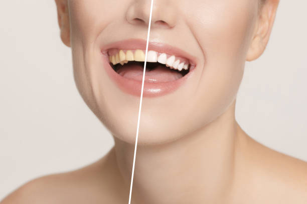 istock The female teeth before and after whitening. 1039811096