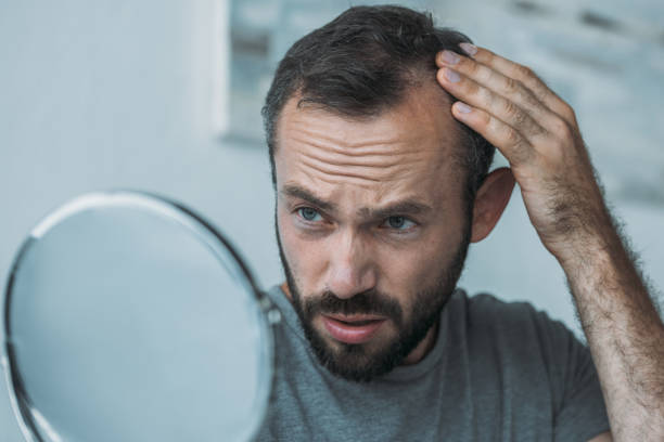 aufgeregt mann mittleren alters mit alopezie blick auf spiegel, haar-verlust-konzept - glatzenbildung stock-fotos und bilder